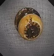 Kurta Button Stuck in Lung Removed via Bronchoscopy at Kolkata Hospital
