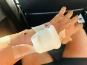 Marathon Runner Injured in Stray Dog Attack During Training