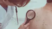 UK Melanoma Cases Hit Record High, Projected to Rise 26% by 2040