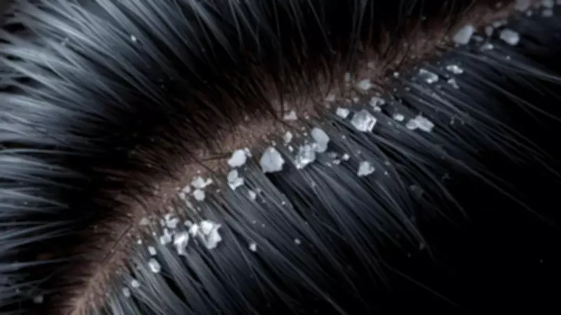 Dandruff Keeps Coming Back? Understand the Science and Find Lasting Relief