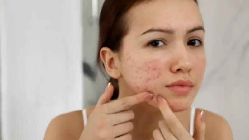 Gut-Skin Axis: How Digestive Health Affects Acne, Eczema, and Rosacea