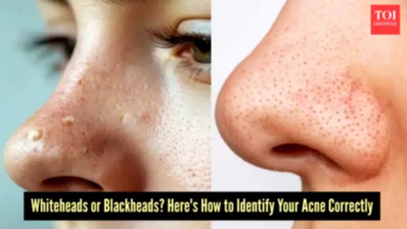 Whiteheads vs Blackheads: Key Differences and Effective Treatments