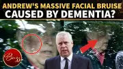 Andrew Windsor's Facial Bruise Sparks Dementia Speculation After Insider Concerns