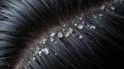 Dandruff Keeps Coming Back? Understand the Science and Find Lasting Relief