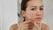 Gut-Skin Axis: How Digestive Health Affects Acne, Eczema, and Rosacea