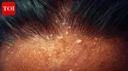 How to Choose the Right Anti-Dandruff Shampoo: Key Ingredients Explained